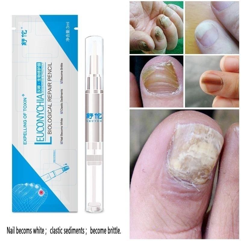 3ml Nail Problem Treatment of Onychomycosis Repair 1 Bottle Bacteriostat  5 Bottles for 30 Days