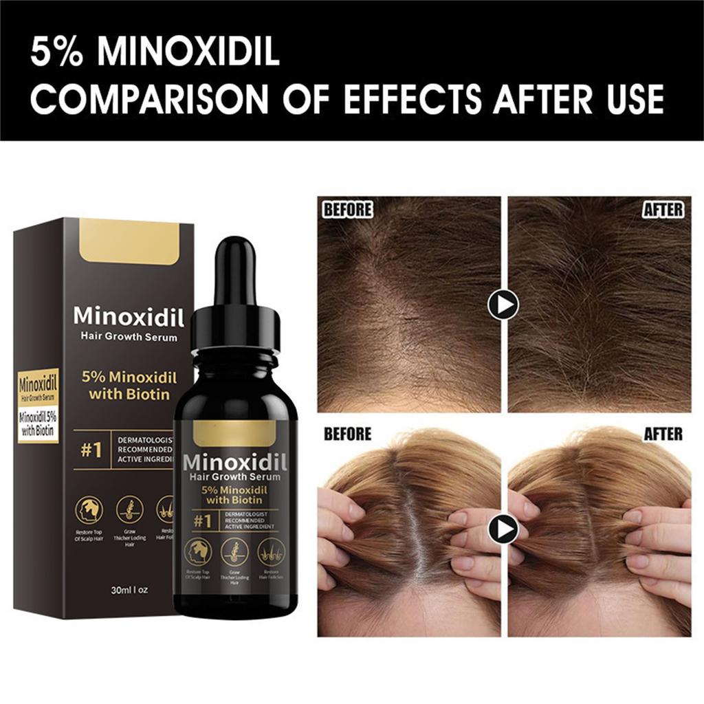 5% Hair Growth For Men And Women - Infused With Biotin, And Panthenol, Prevent Hair Loss 30ml