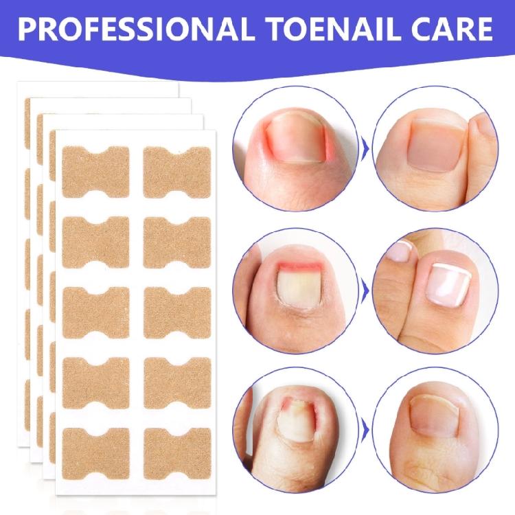 100pcs Paronychia Toenail Corrector Ingrown Patch Foot Care Nail Repair Patch