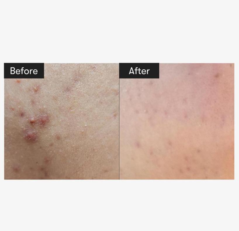 VT Reedle Shot 100 Essence 50ml | Gentle Micro-Needle Skincare for Daily Use