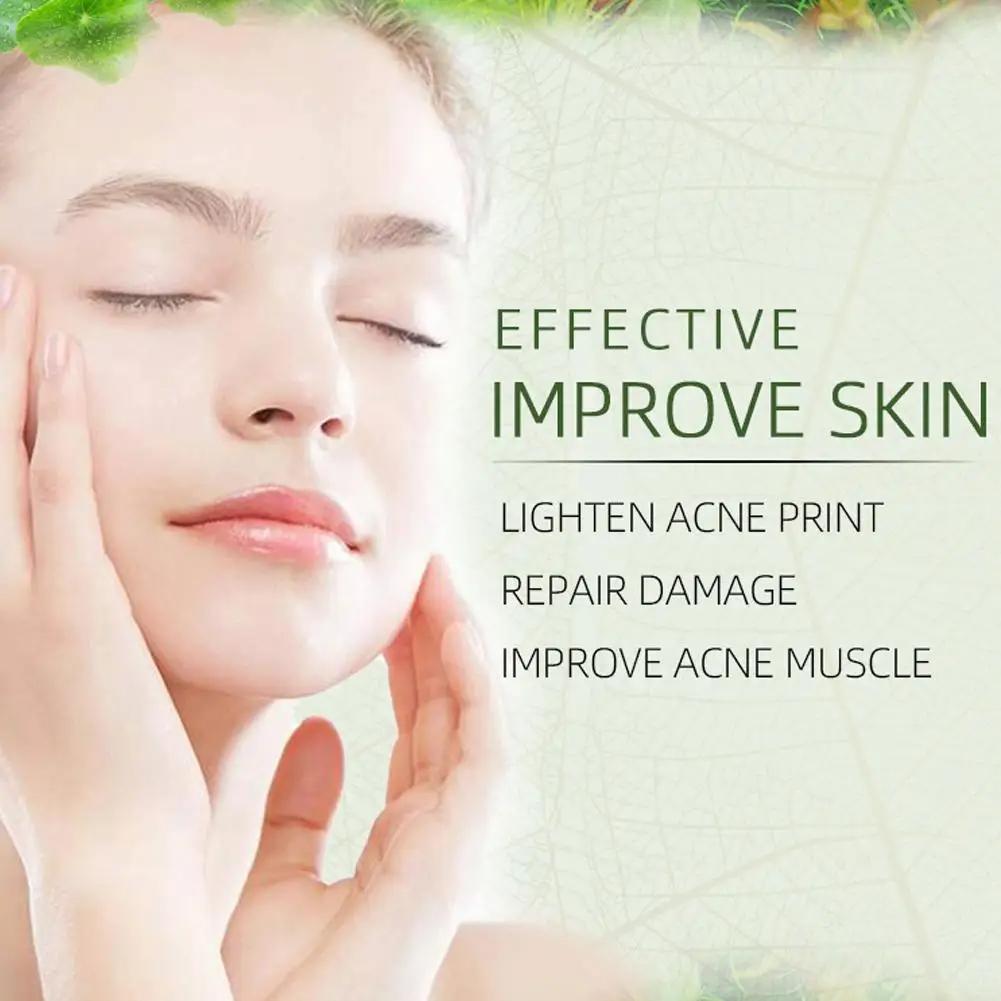 Crème anti-acné pour le visage, élimine les pores dilatés, traite l'acné, contrôle du sébum, réduit les pores, crème pour le visage, soins de la peau, beauté et santé