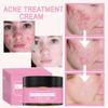 Crème hydratante nourrissante et hydratante pour éliminer l'acné, réparation douce des fosses d'acné, marques d'acné