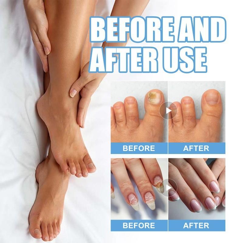 Ximonth Nagelreparatur-Pflaster Weiches Gel Verdickende Nagelpflege Zur Behandlung von Pilzinfektionen