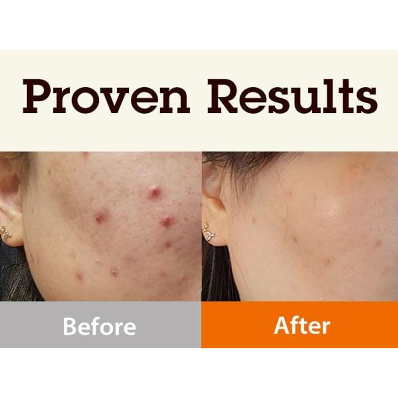 BLITHE Targeted Blemish Serum Tranexamic Acid 3.0