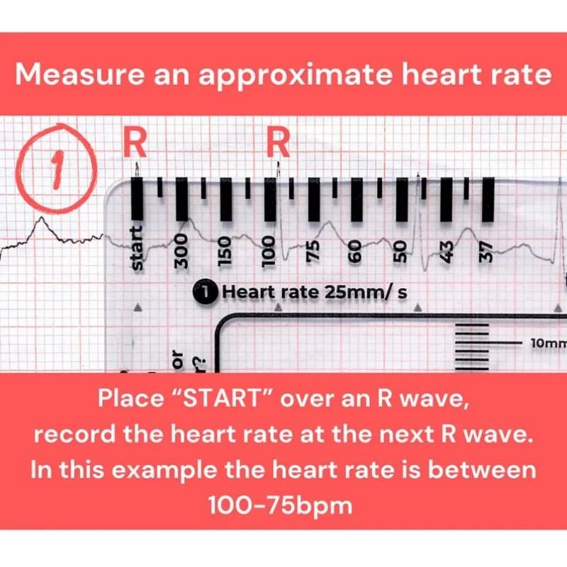 EKG 7stupňové pravítko Přenosné průhledné 7stupňové pravítko Měřicí nástroj Plastové pravítko Měřicí nástroj pro interpretaci EKG