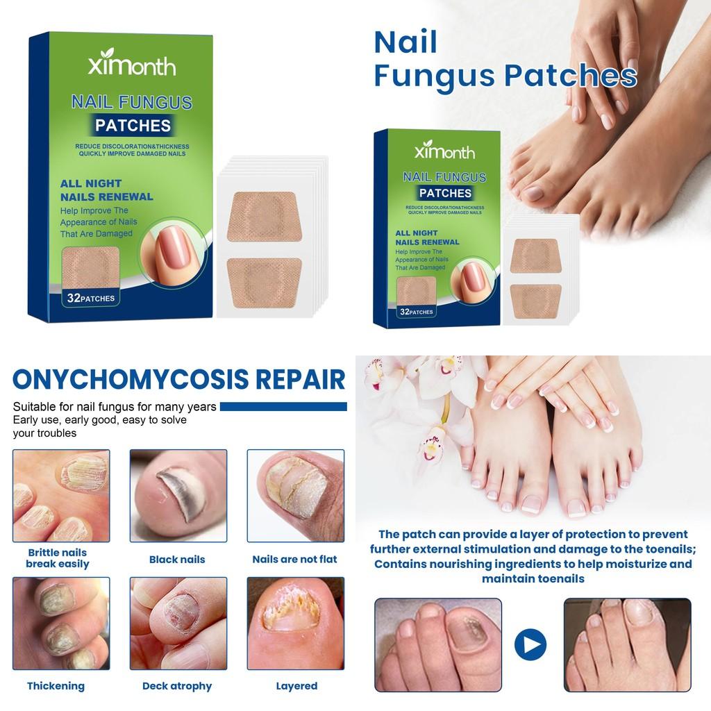 Patchs Réparateurs pour Ongles d'Orteil Ximonth Pour Soin Nourrissant et Adoucissant des Ongles Fongiques