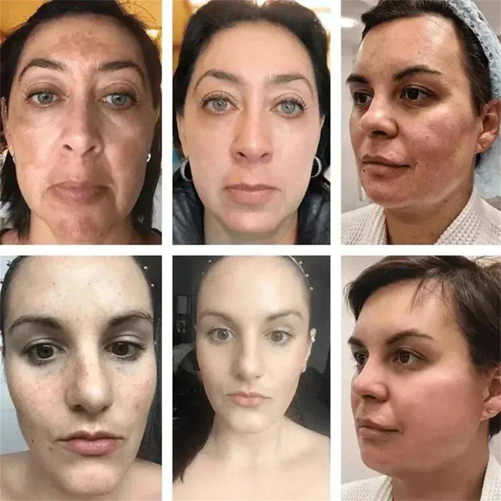 Powerful Spot-Removing Whiten Cream Brighten Skin Fast Eliminates Melanin Pigmentation Melasma Dark Spots Korean Face Skin Care