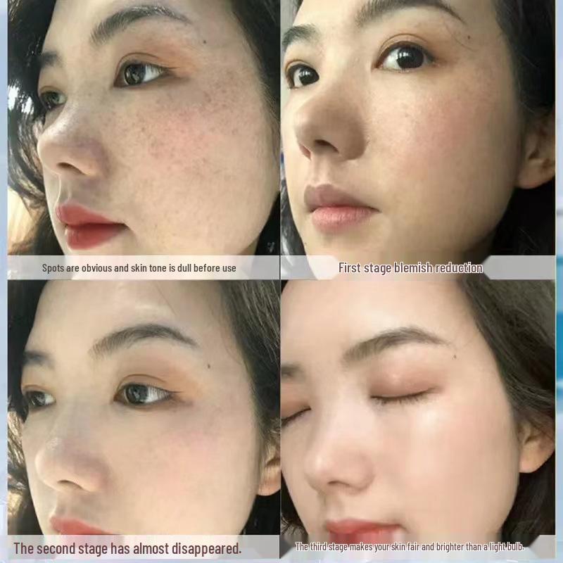 Tranexamic Acid Brightening Face Cream for Melasma, Age Spots, Freckles, and Dark Spot Correction