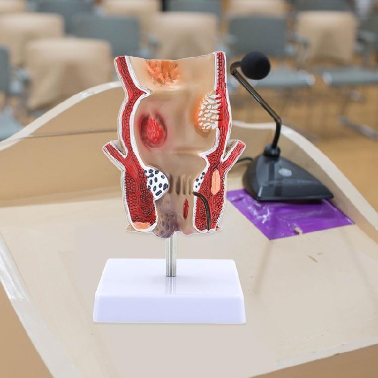 Modèle Anatomique Humain Modèle de Rectum Humain Modèle des Pathologies du Rectum Humain Support Pédagogique pour l'Éducation Scientifique