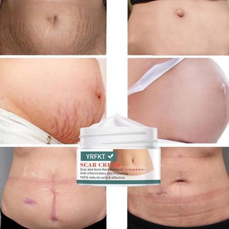 Deeply Permeate Cuticle Skin Care Acne Stretch Scar Cream