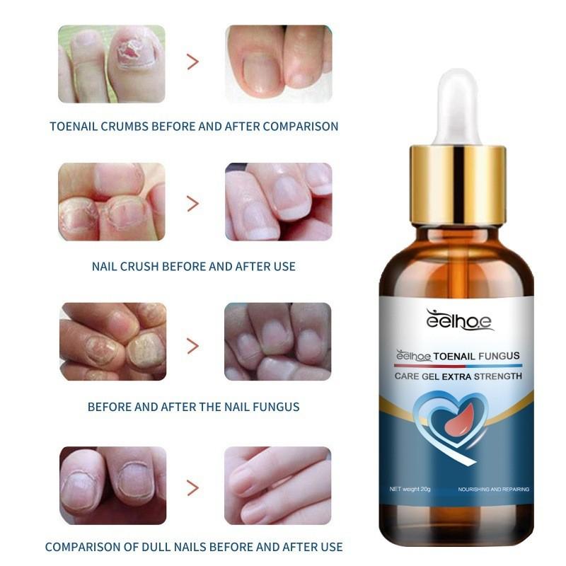 Eelhoe Toenail Care Gel For Yellow Thickened Nails With Fortifying And Restorative Formula
