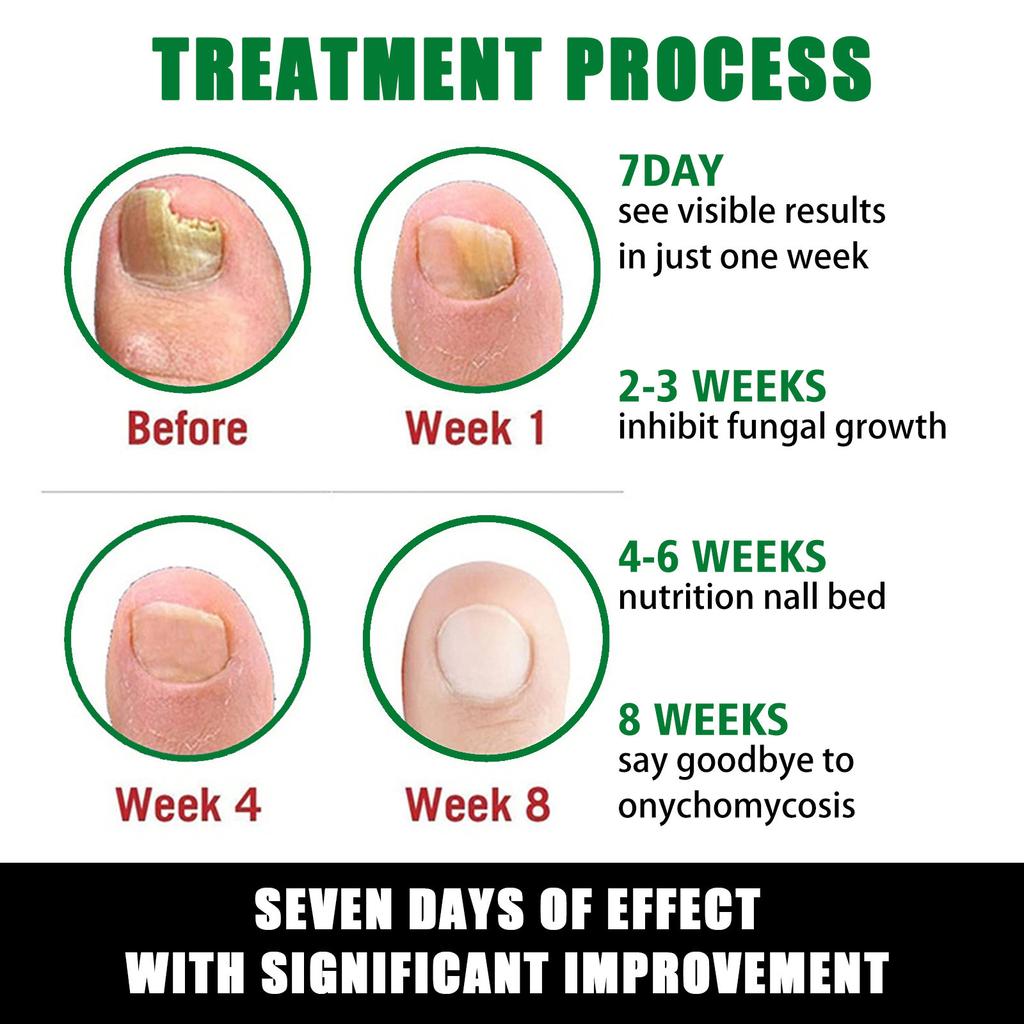 Toenail Fungus Care, FastActing Nail Care Liquid For Fungus Under & Around  Restores The Healthy Appearance Of Nails 30ml