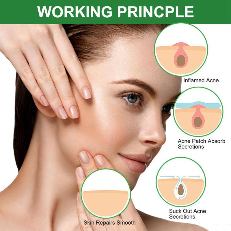 Наклейки от прыщей. Пластырь на прыщ на лице. Cosrx acne pimple master patch пластыри от прыщей. Круглые пластыри от прыщей. Гидроколлоидный пластырь от прыщей.