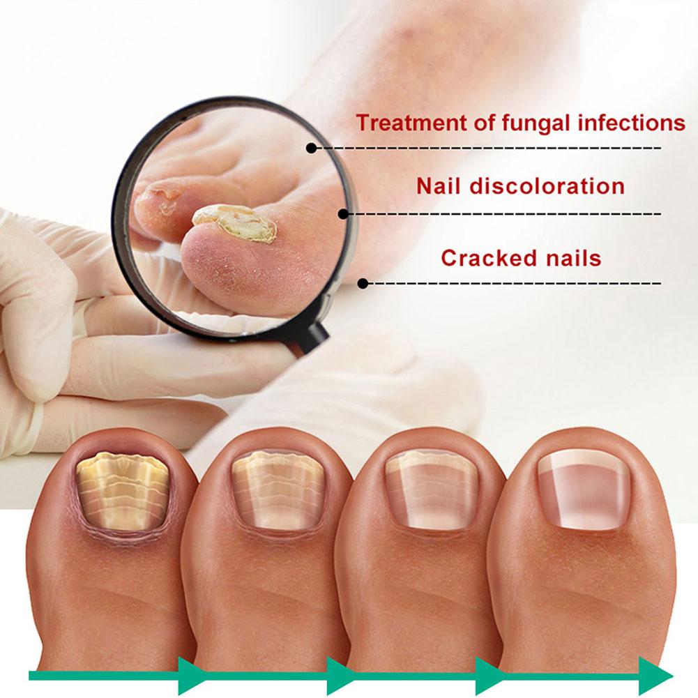 Extra Strong Nail Fungus Treatment Serum Essence Care Repair Essence Anti Toe Infection Gel Feet Serum Removal Nails Fungal