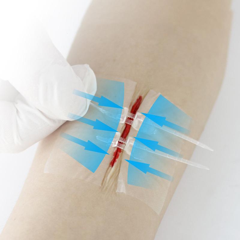 1/2Pcs Zipper Tie Wound Closure Patch Hemostatic Patch Wound Fast Suture Zipper Band-Aid Outdoor Portable