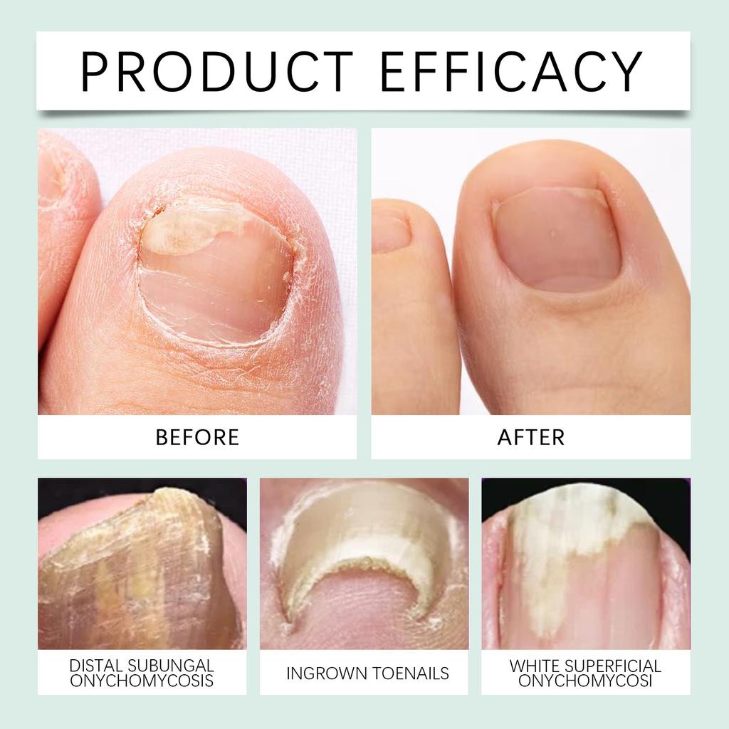 Fungus Pen, Onychomycosis Care Toenail Liquid 3ml