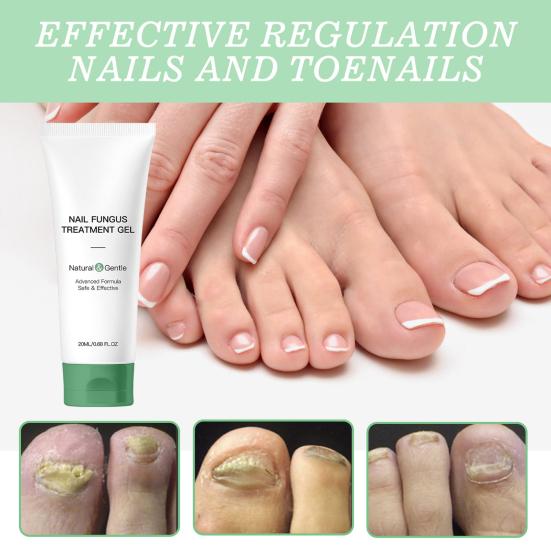 1/2Pcs 20ML Nail Fungus Treatment Gel Natural Ingredients Portable Men Women Hydrating Moisturizing Multi-Purpose