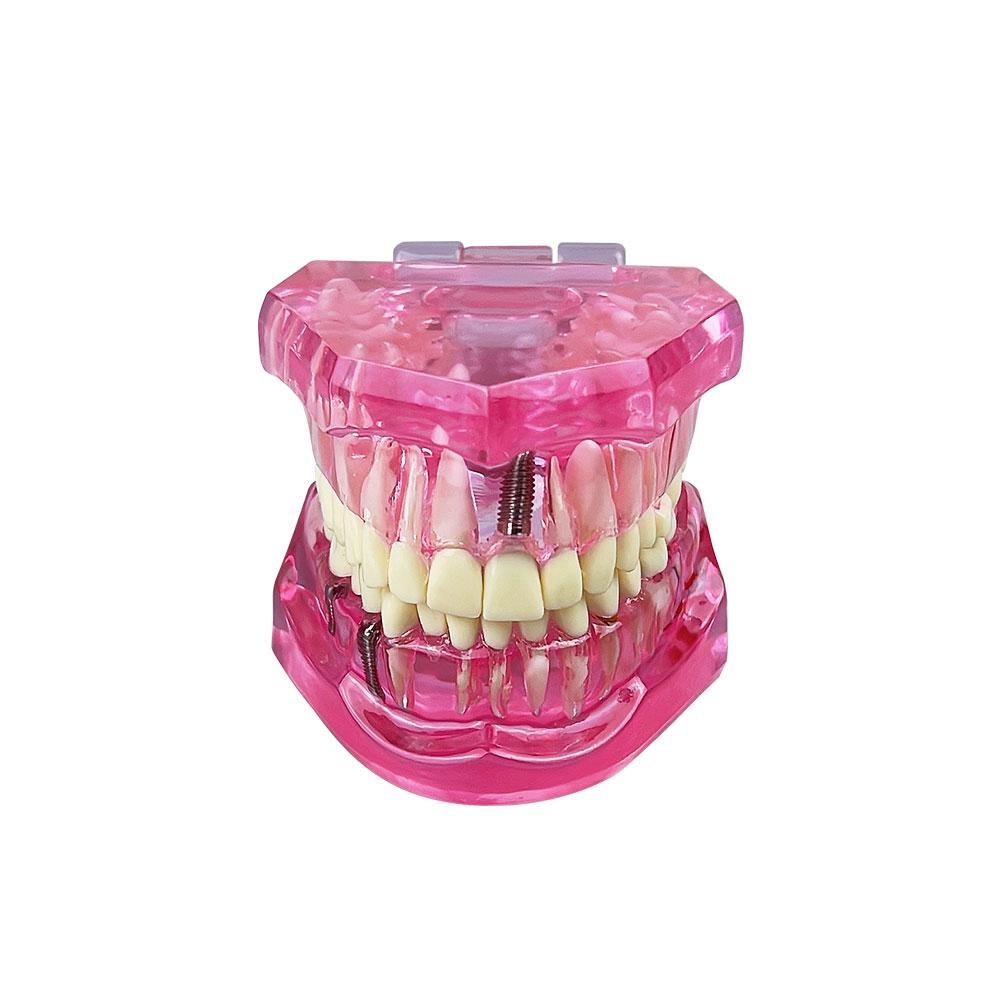 Teeth Model Implant Disease Dentist Studying Model With Restoration Bridge Tooth Demonstration Models For Patient Education