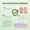 South Moon Acne Gel For Clear And Radiant Skin 30ml Blemish Reducing Formula