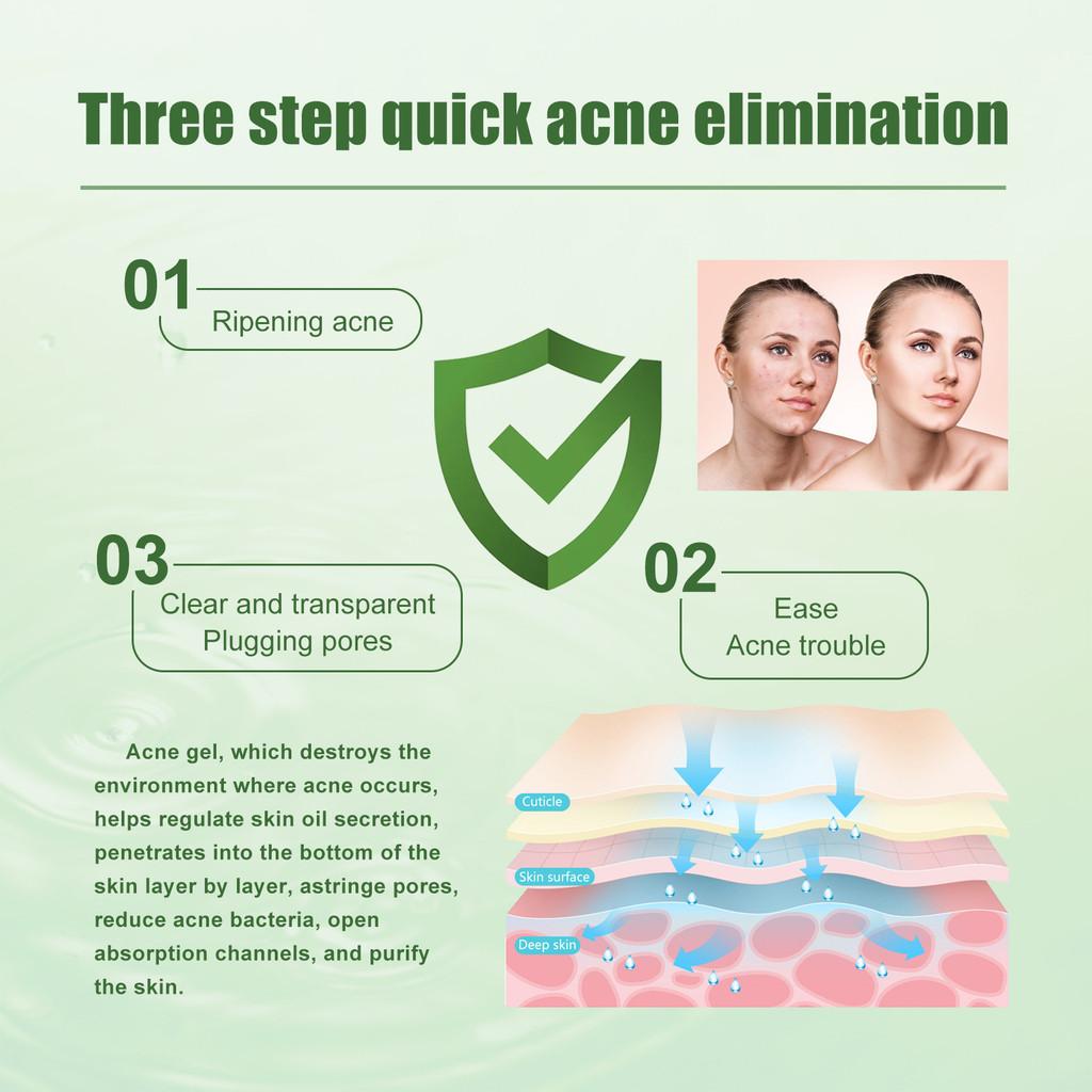 South Moon Acne Gel For Clear And Radiant Skin 30ml Blemish Reducing Formula