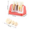 1pc Resin Dental Demonstration Tooth Model Implant Analysis Crown Bridge for Dentist
