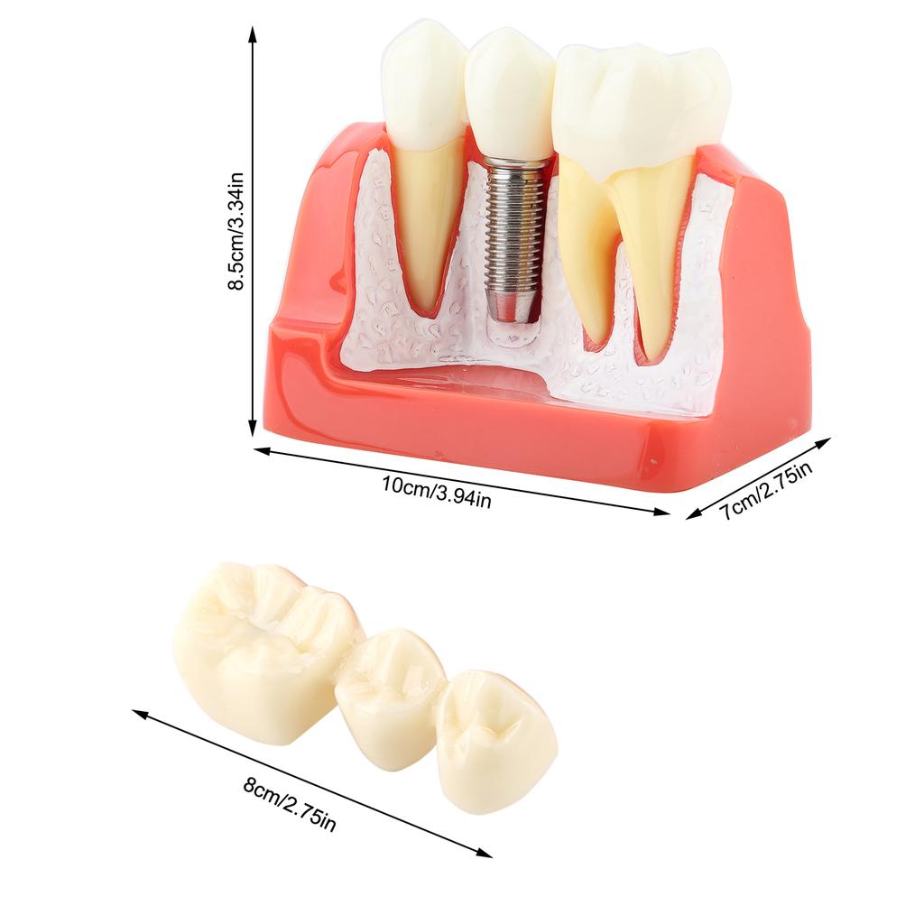 1pc Resin Dental Demonstration Tooth Model Implant Analysis Crown Bridge for Dentist