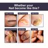 OUHOE Nail Repair Essence Soft Nail Thickening Nail Smoothing Endogenous toenail Nail Fungus Repair Essence