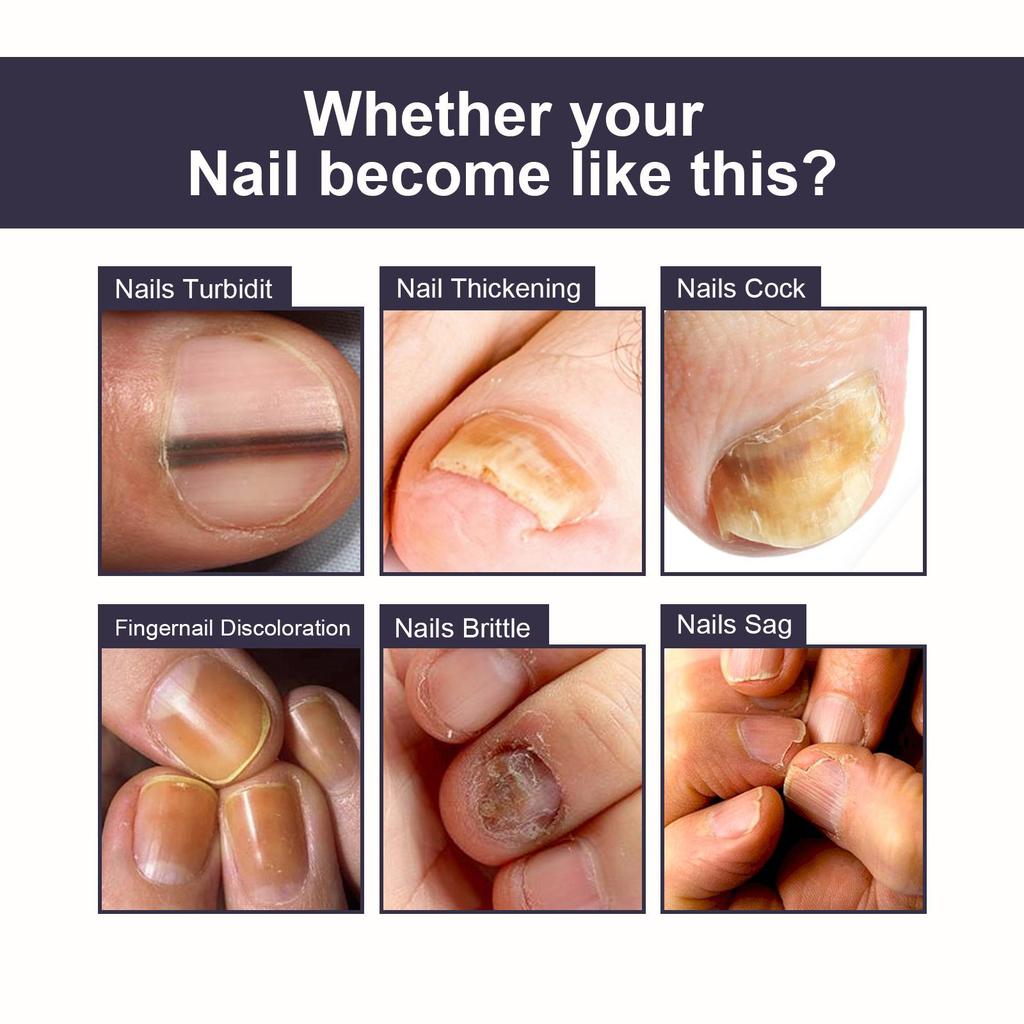 OUHOE Nail Repair Essence Soft Nail Thickening Nail Smoothing Endogenous toenail Nail Fungus Repair Essence