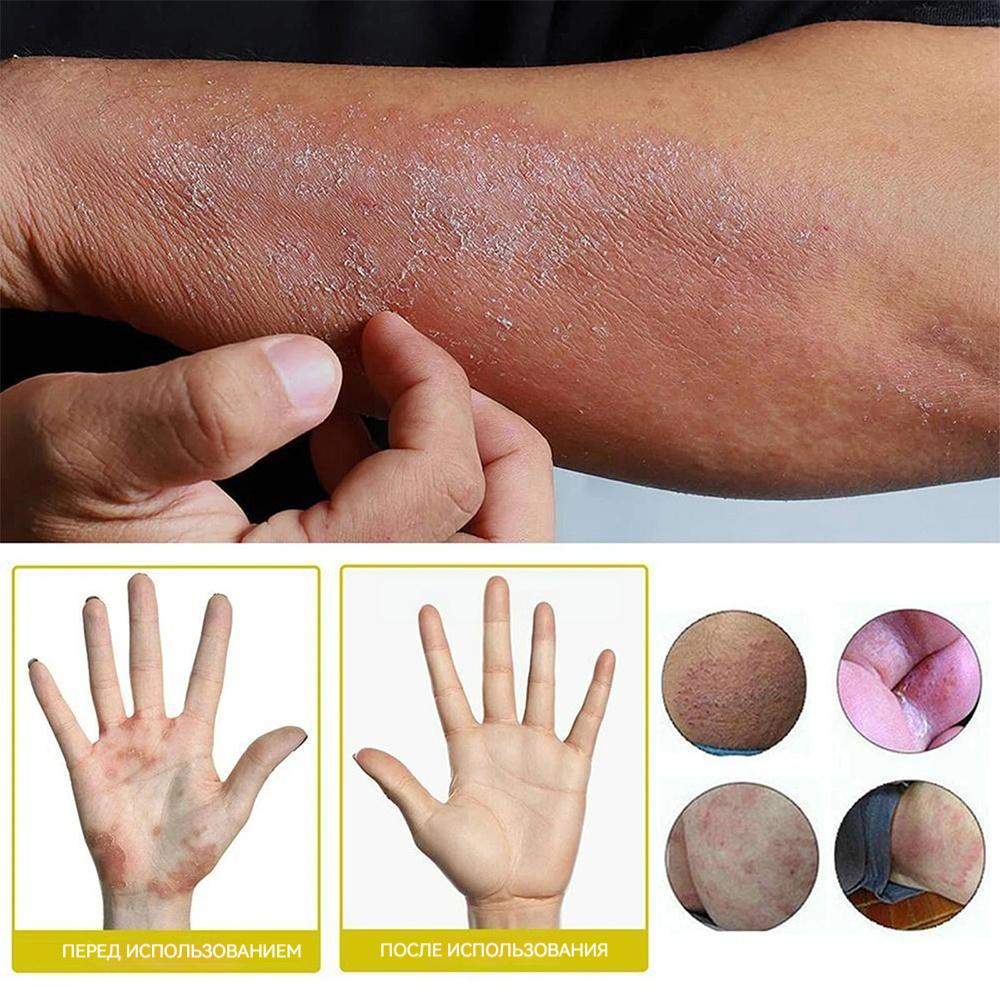 sulfuric Moss Care Relieves Skin Itching, Redness, And Swelling. Cowhide Moss Moisturizing Skin Care