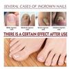 Ingrown Nail Oil