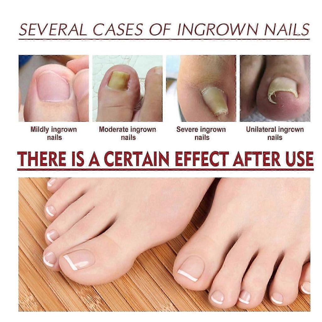 Ingrown Nail Oil