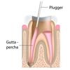 GDC Root Canal Plugger Luks - (.50mm) (.75mm) RCP5/7 #3