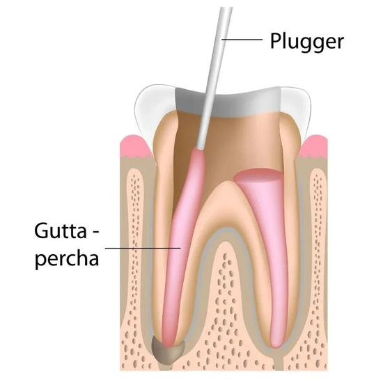 GDC Root Canal Plugger Luks - (.50mm) (.75mm) RCP5/7 #3