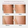 Strawberry Skin Treatment, Strawberry Legs Resurfacing Cream with Brush, Advanced Triple-Acid Complex, Reduce Chicken Skin Bumps