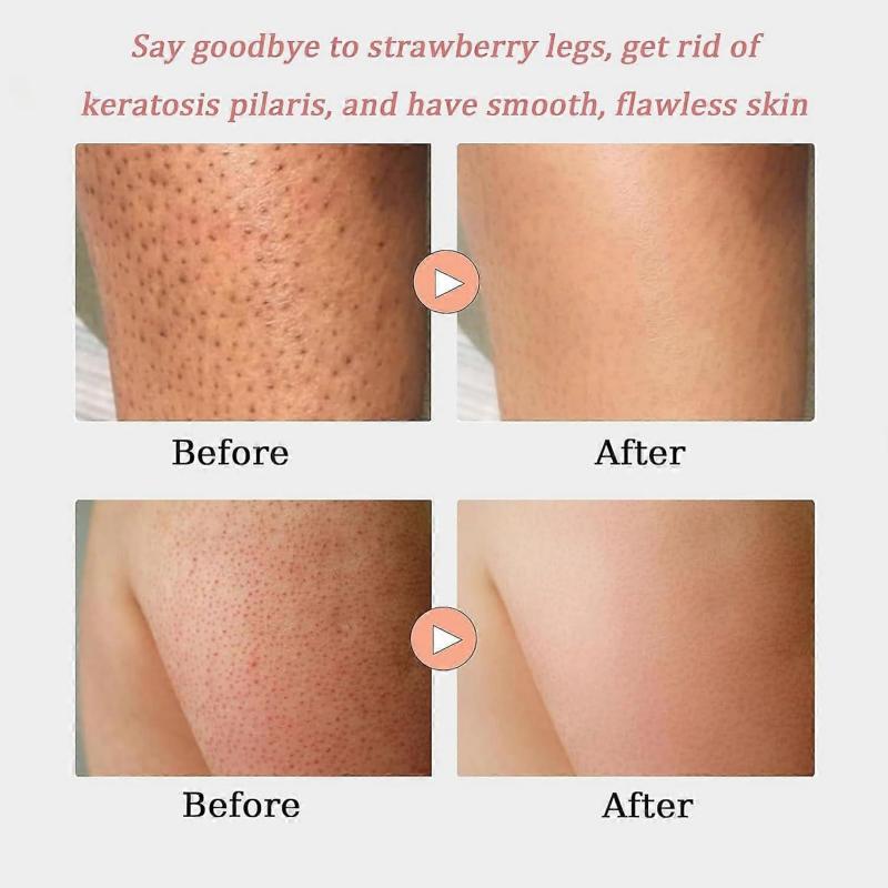 Strawberry Skin Treatment, Strawberry Legs Resurfacing Cream with Brush, Advanced Triple-Acid Complex, Reduce Chicken Skin Bumps