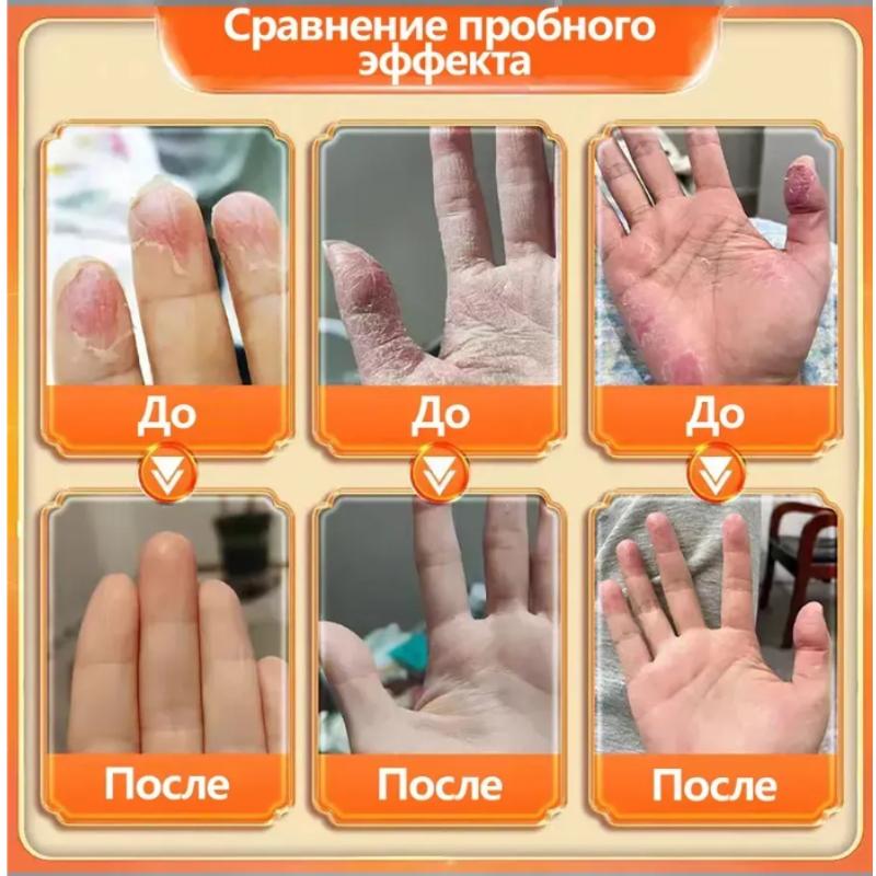 Medical Ointment for the Treatment of Cracks on Hands and Feet, 50g