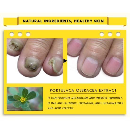 OEDO Nail Treatment Essence Oil Moisturizing Fungus Removal Foot Care Liquid