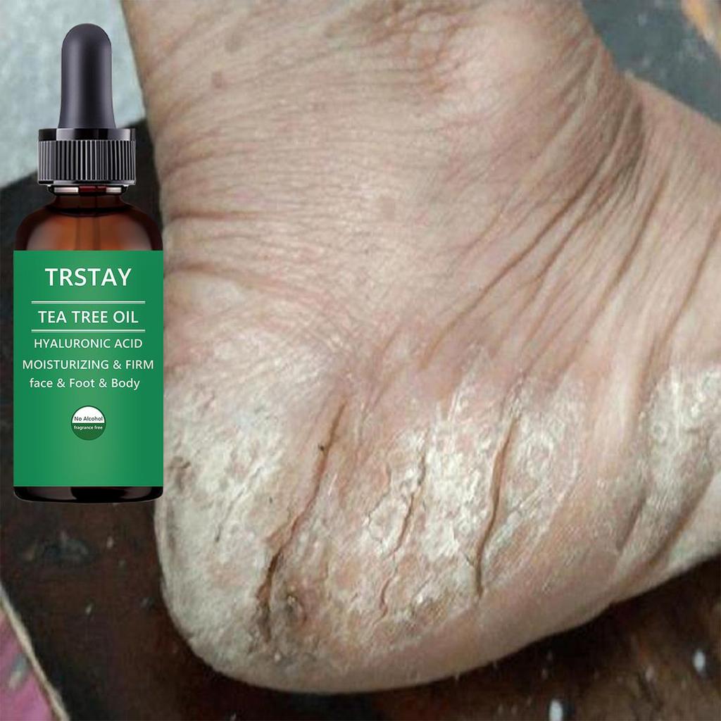 Fotbehandling:  Botanisk fotkrem Fuktighetsgivende fotpleieessens for tørr hud, sprukne hæler, sterk helbredende kraft, soppdrepende