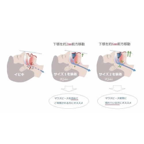 ZQuiet Made In USA Size 1 Jaw Forward Movement 2mm Snoring Mouthpiece (Main Unit Only) Snoring Relief Aid (1)