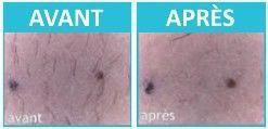 Epil Xpress Hair Reduction Lotion for the Face