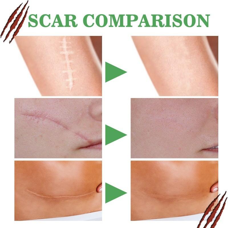 Ouhoe Scar Repair Serum For Smooth Skin Reduces Scars From Surgery And Pregnancy 30ml