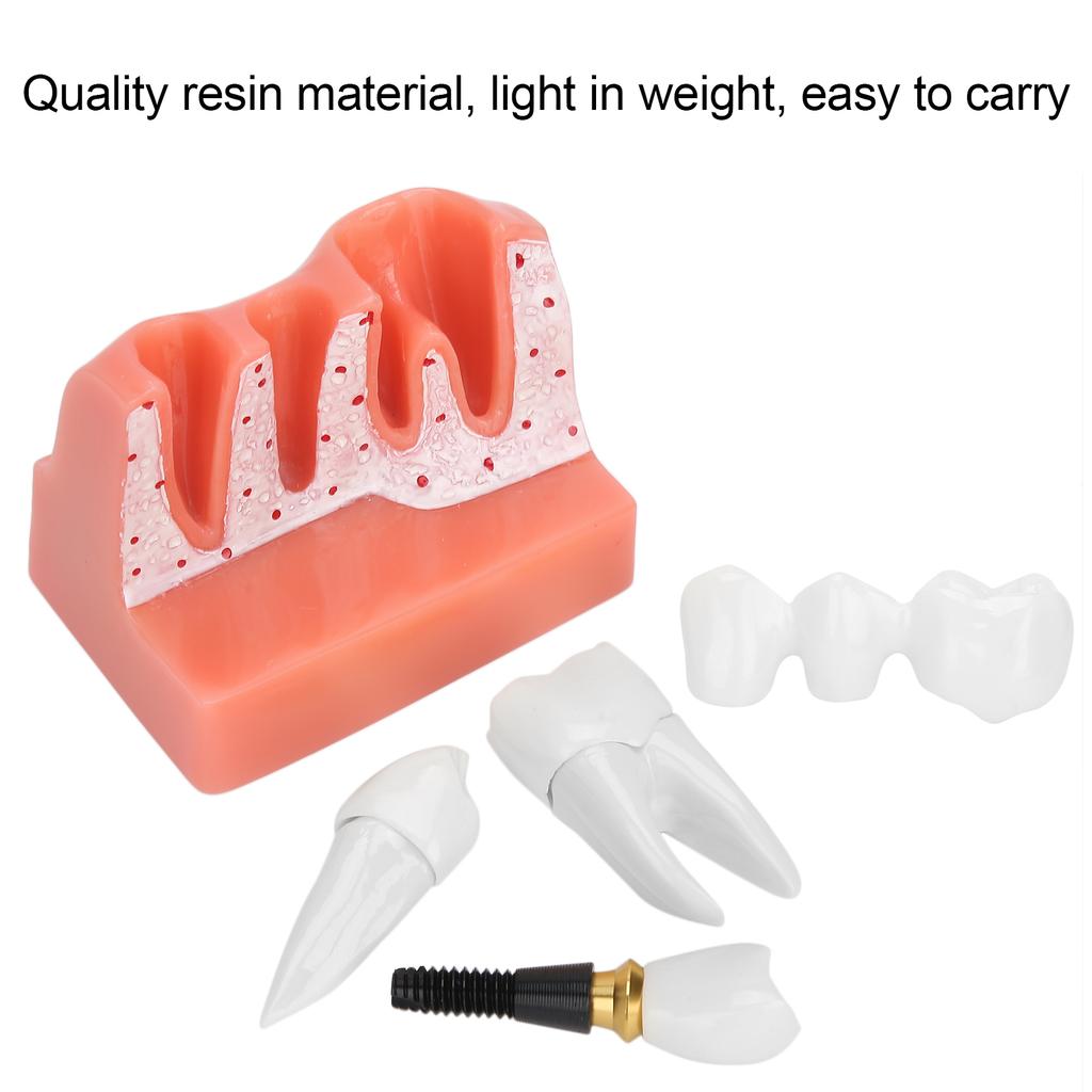 Model zubů Analýza zubního implantátu Demonstrační model korunkového můstku Model zubu