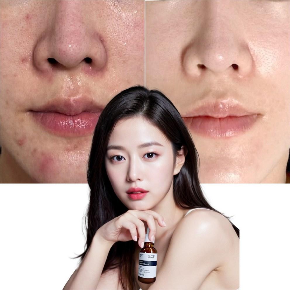 [MUAMA] Acne Treatment Serum 30ml x 2-Set - Clinical Trial Completed High-Content Retinol & Heartleaf Ampoule for Sebum & Pore Control