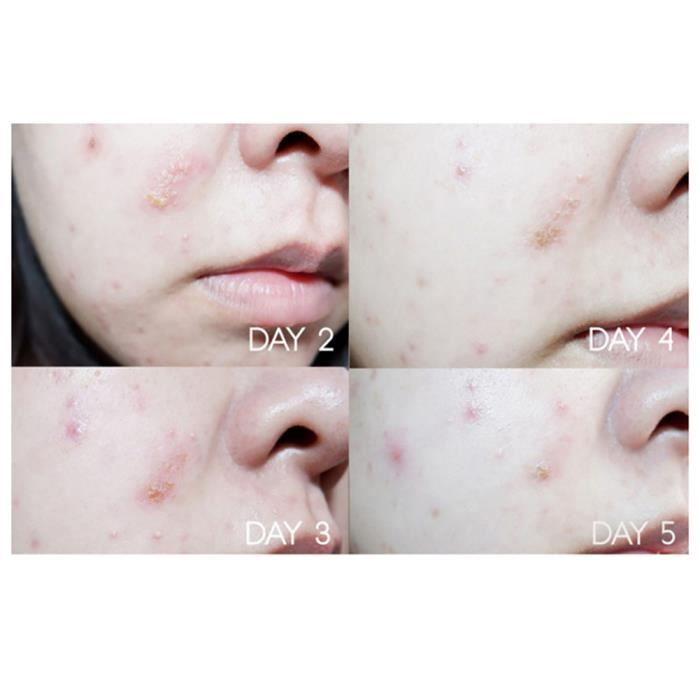 The Ordinary Solution D'acide Salicylique À 2% 30 Ml