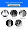 Forefoot Pressure Relief Shoes for Postoperative Foot Injury and Hallux Fracture Recovery