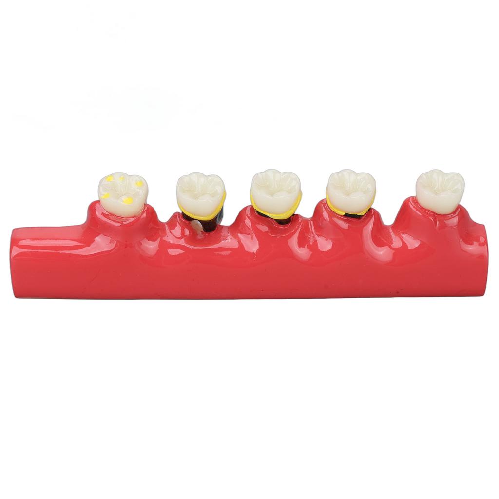 Dental Teeth Model Ceramic Clear Structure Oral Care Educational Periodontal Disease Model
