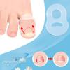Ingrown Toenail Correction Ring - Stretchable Nail Groove Fixator for Repeated Use