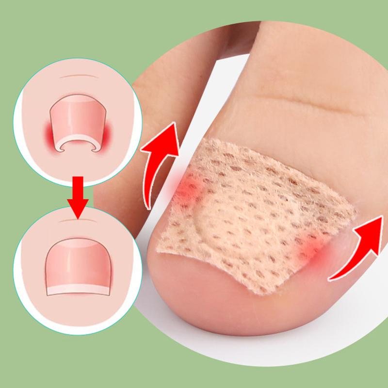 Nail Patch Ingrown Toenail Correction Nail Sticker Foot Pulling Patch Glue-Free Foot Sticker Nail Groove Ingrown Toenail Correction Nail Care Patches
