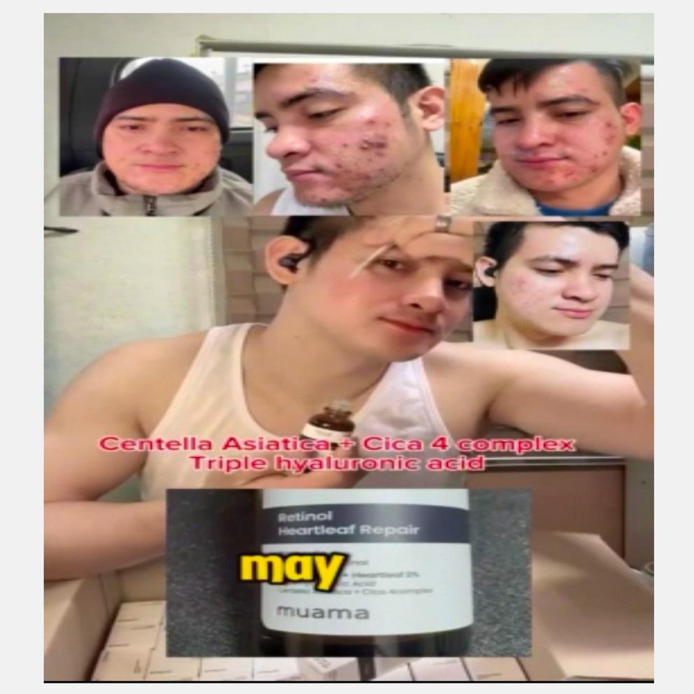 [MUAMA] 3-Tage Aknebehandlungs-Ampulle - Beruhigend, Talgreduzierend, Porenverfeinernd, Retinol, Houttuynia Cordata, Hyaluronsäure, Niacinamid, 30ml