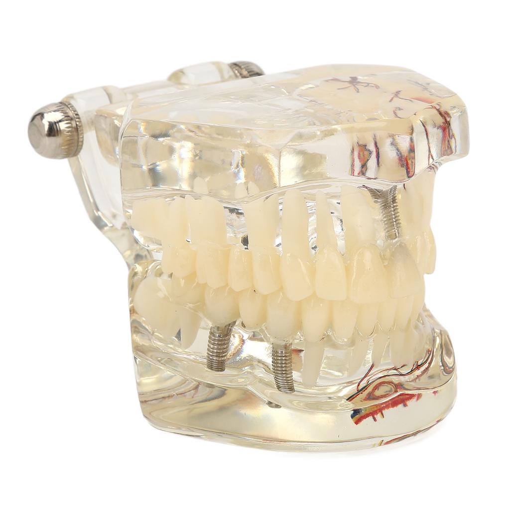 Transparent Dental Implant Pathological Model Implant Disease Teeth Model for Teaching Demonstration